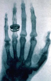 X-ray image of hand